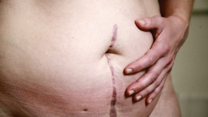 Photo par Shane topless woman with skin condition